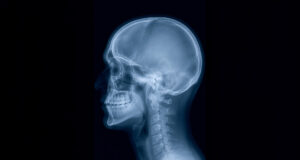 Radiografía cráneo humano